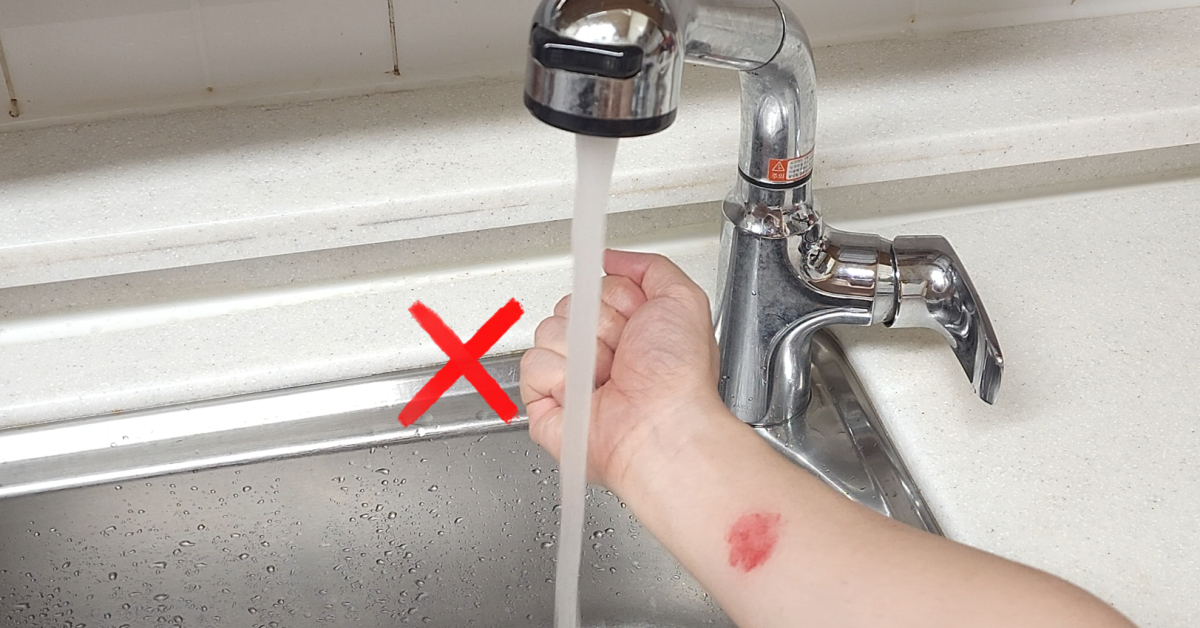 화상 입었을때 절대 '이것' 하지마세요! 그동안의 화상 대처법은 모두 틀린 꿀팁이었습니다. 1