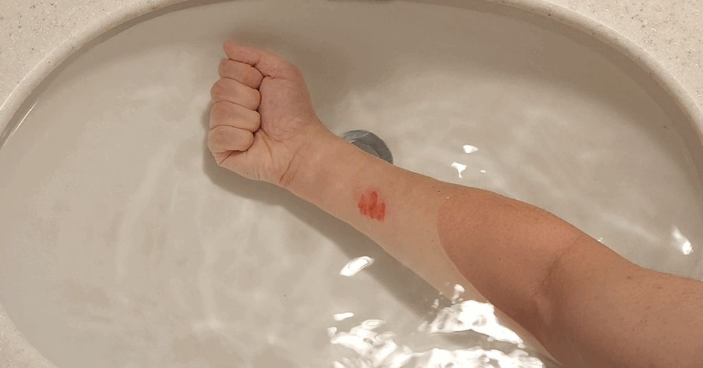 요리나 일상 중 생길 수 있는 화상, 잘못된 대처는 흉터를 남깁니다. 올바른 화상 대처법과 뜨거운 물 화상 응급처치 방법을 단계별로 알려드립니다. 