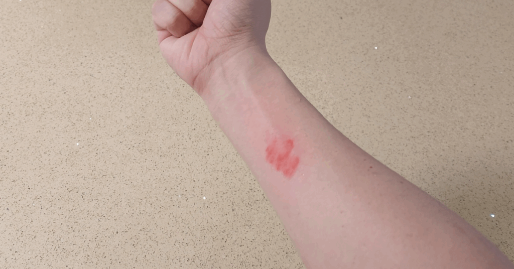 요리나 일상 중 생길 수 있는 화상, 잘못된 대처는 흉터를 남깁니다. 올바른 화상 대처법과 뜨거운 물 화상 응급처치 방법을 단계별로 알려드립니다. 